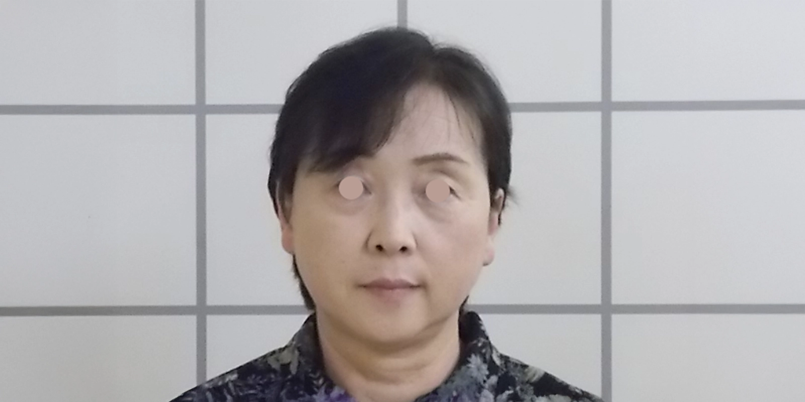 治療前