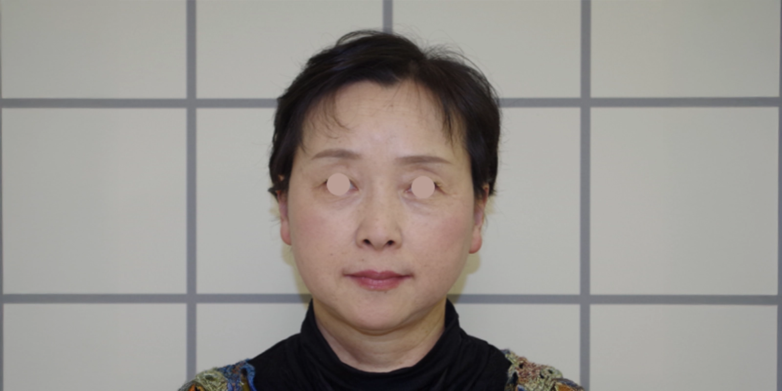 治療後