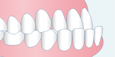 下顎前突（受け口・反対咬合）