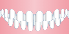 空隙歯列（すきっ歯）