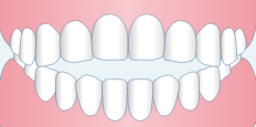 開咬（前歯で咬むことができない）
