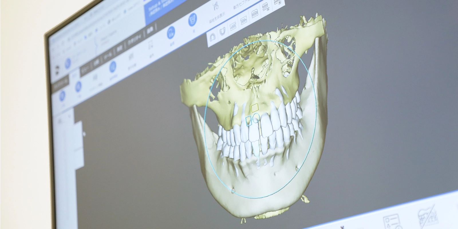 自覚症状から見る顎関節症のサイン